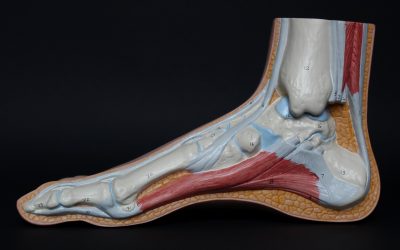 Can Chiropractic Care Help Plantar Fasciitis?